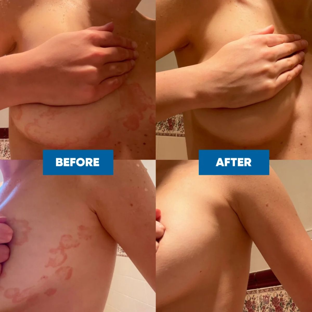 MooGoo - Eczema & Psoriasis Cream with Marshmallow, Elderberry & More