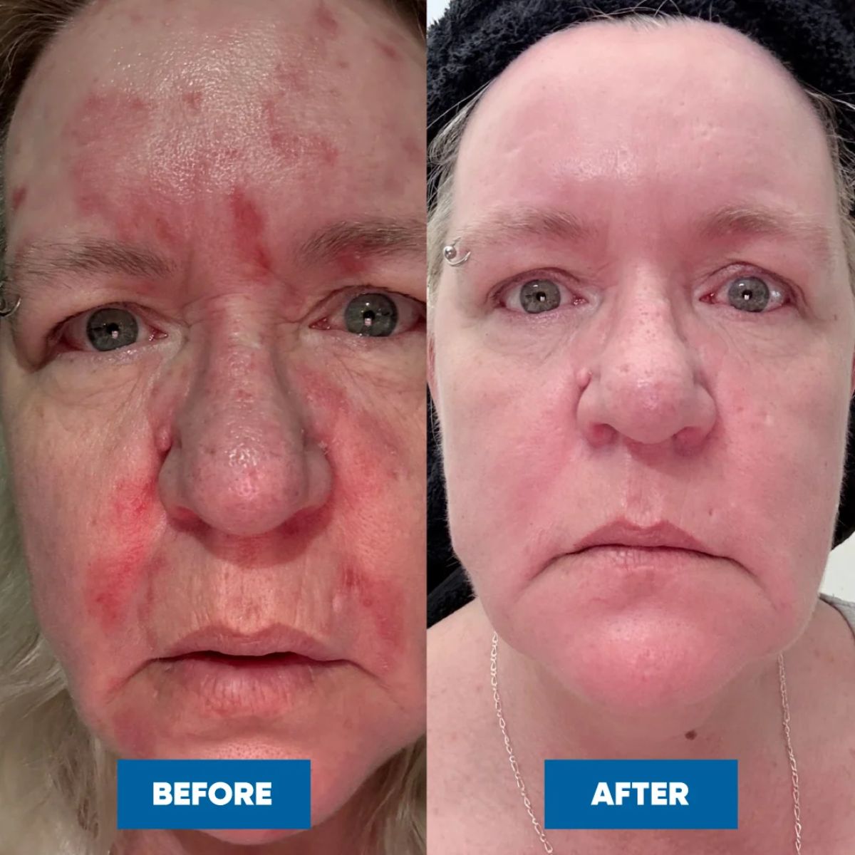 MooGoo - Eczema & Psoriasis Cream with Marshmallow, Elderberry & More