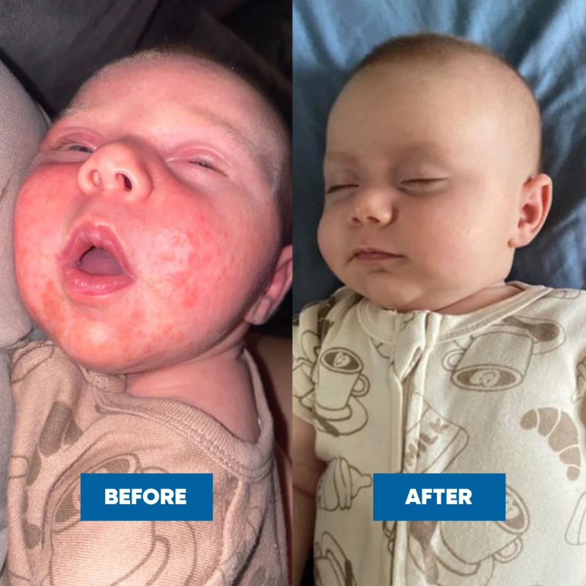 MooGoo - Eczema & Psoriasis Cream with Marshmallow, Elderberry & More