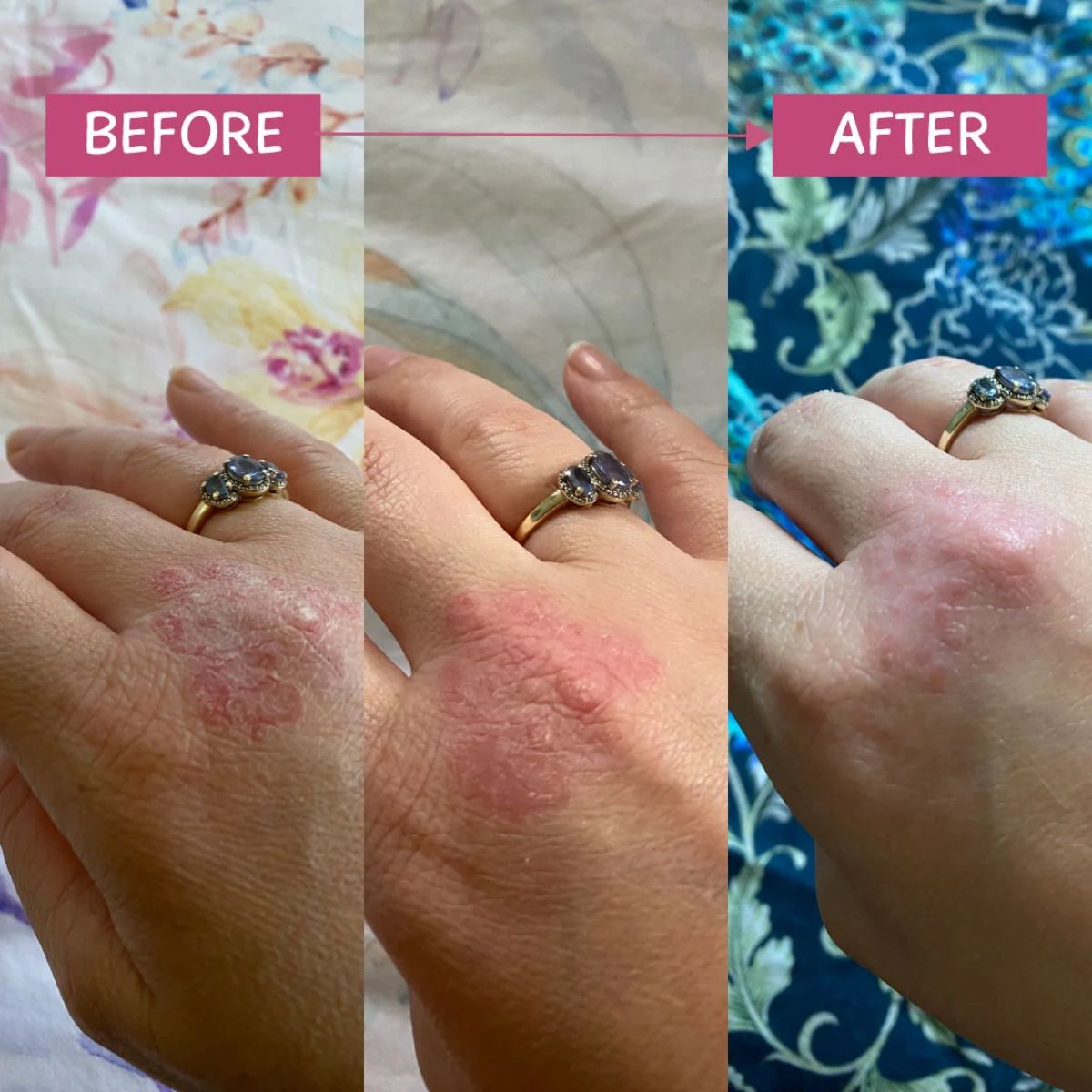 MooGoo - Pink Eczema Cream with Vitamin B12 & Nigella Sativa Oil