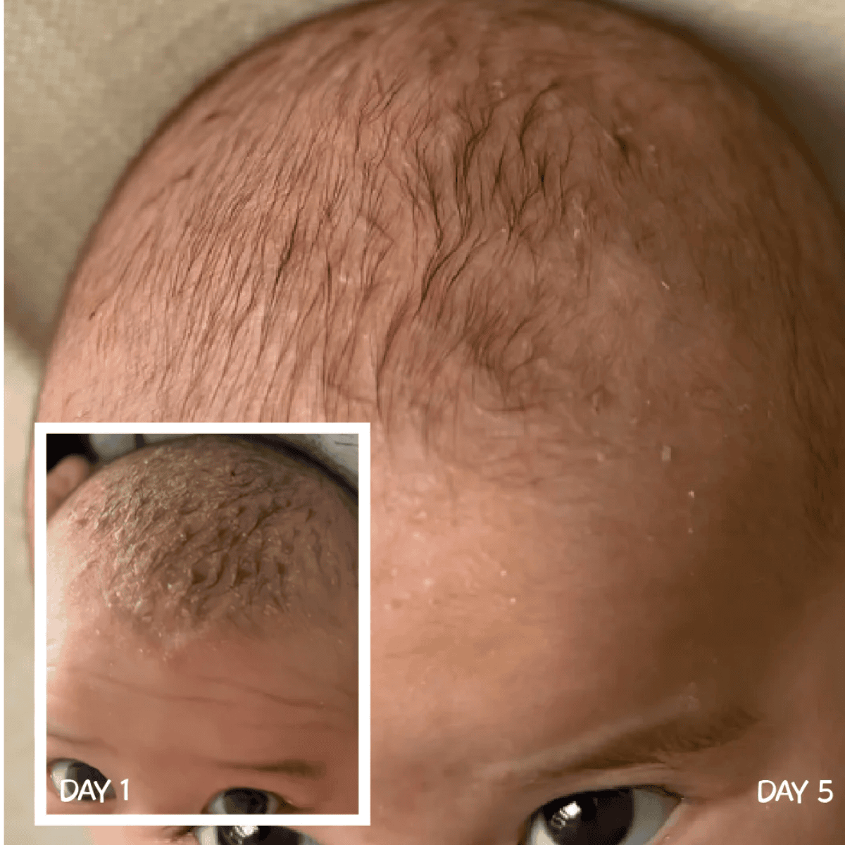 Close-up of a person's scalp with hair growth progression from Day 1 to Day 5.