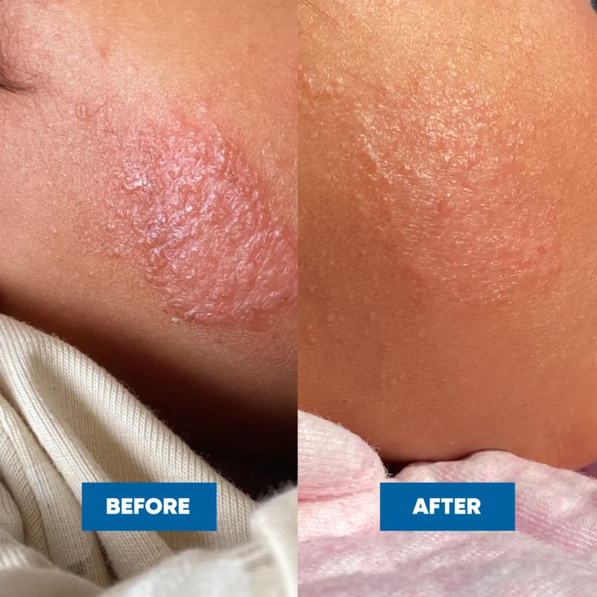 MooGoo - Eczema & Psoriasis Cream with Gotu Kola, Chamomile & More