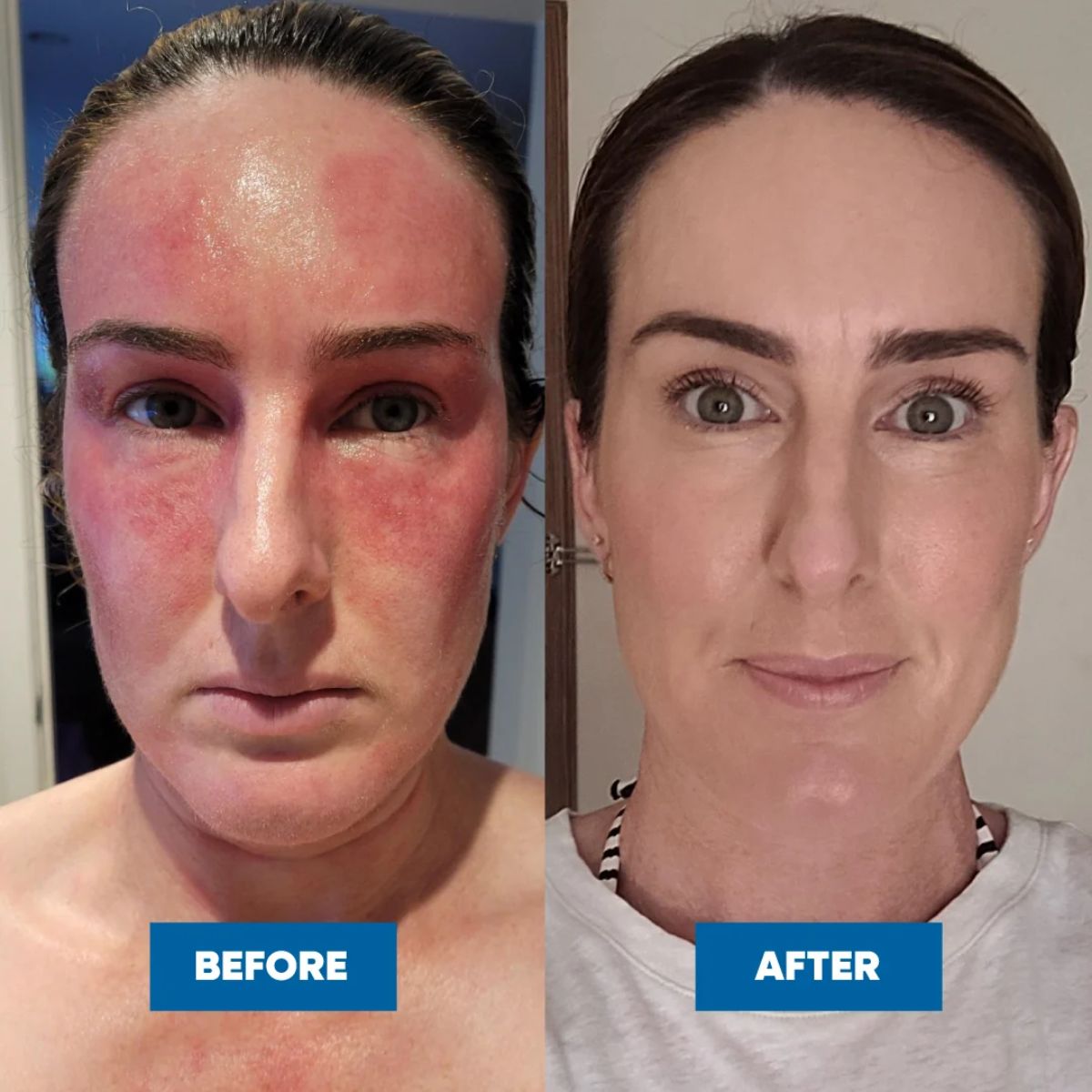 MooGoo - Eczema & Psoriasis Cream with Gotu Kola, Chamomile & More