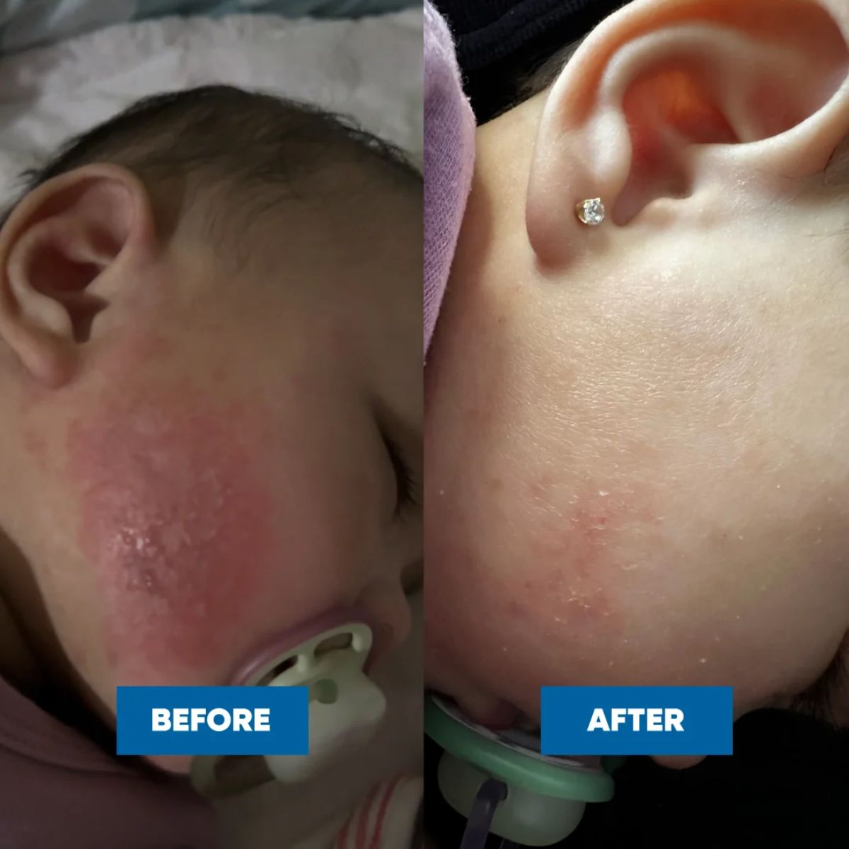 MooGoo - Eczema & Psoriasis Cream with Gotu Kola, Chamomile & More
