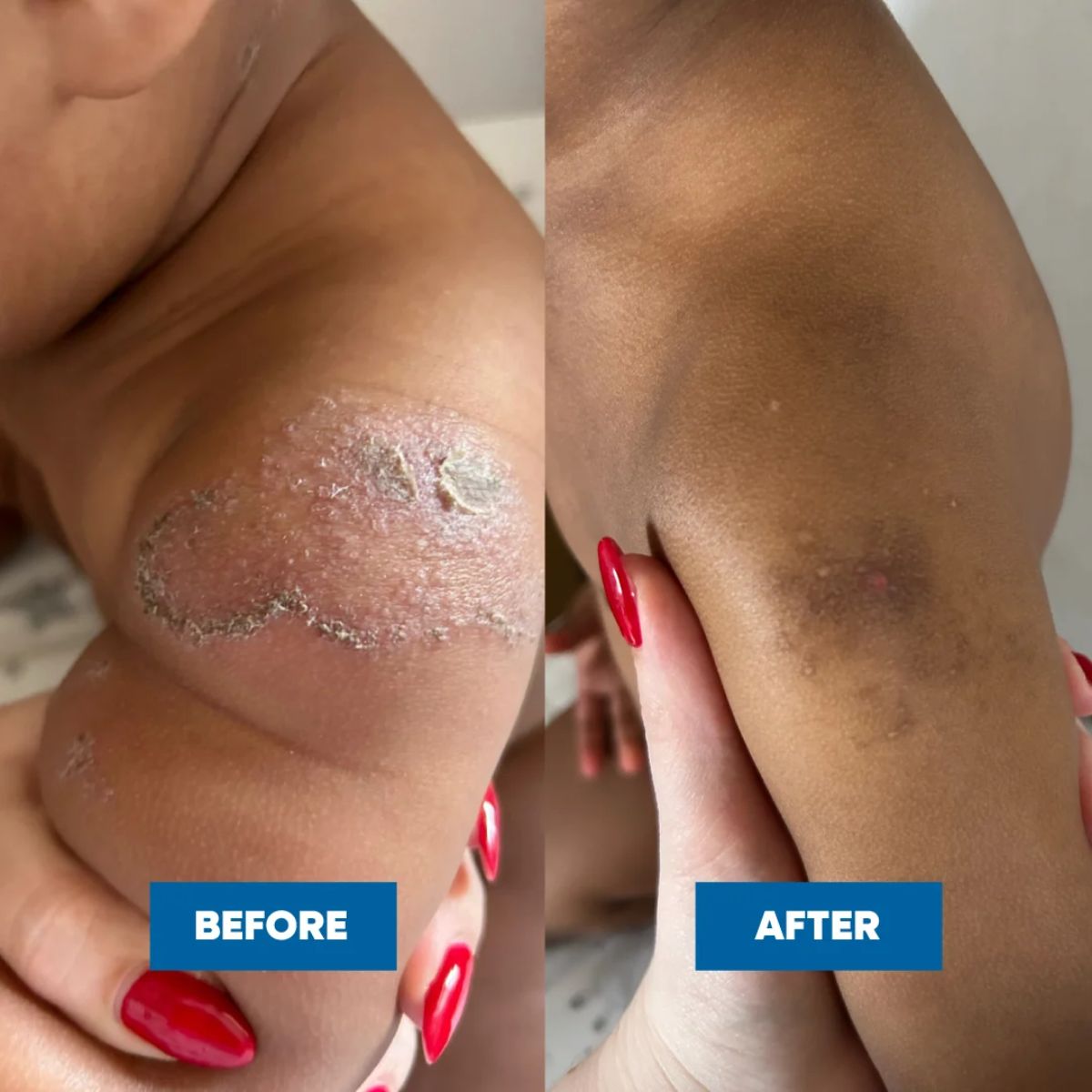 MooGoo - Eczema & Psoriasis Cream with Gotu Kola, Chamomile & More