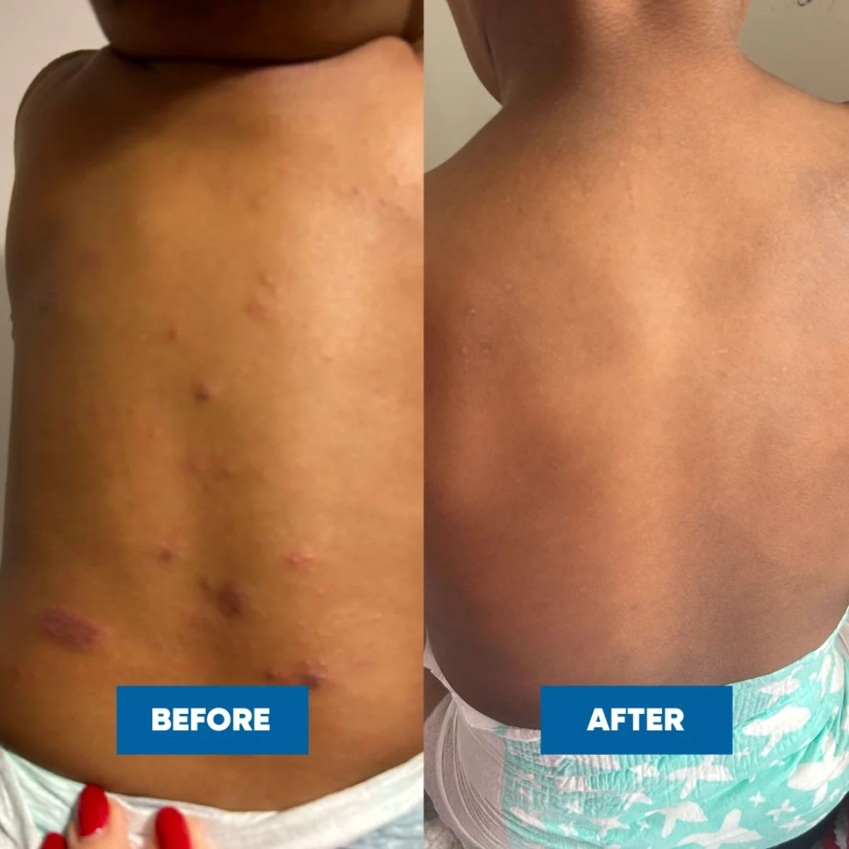 MooGoo - Eczema & Psoriasis Cream with Gotu Kola, Chamomile & More