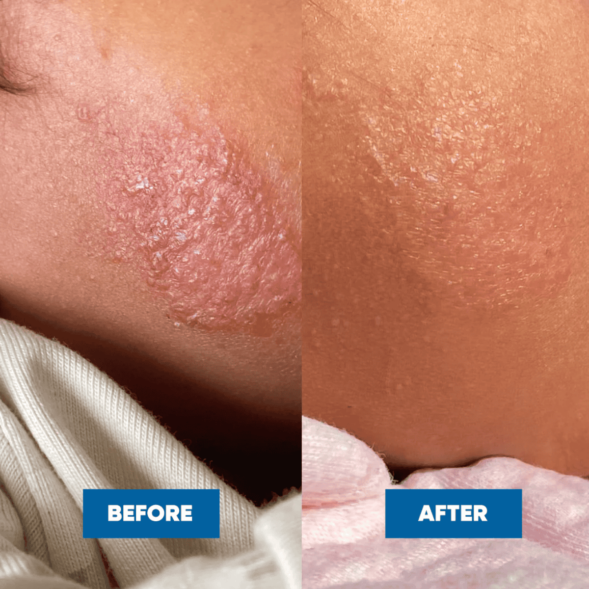 Before and after comparison of skin texture on a person's arm.