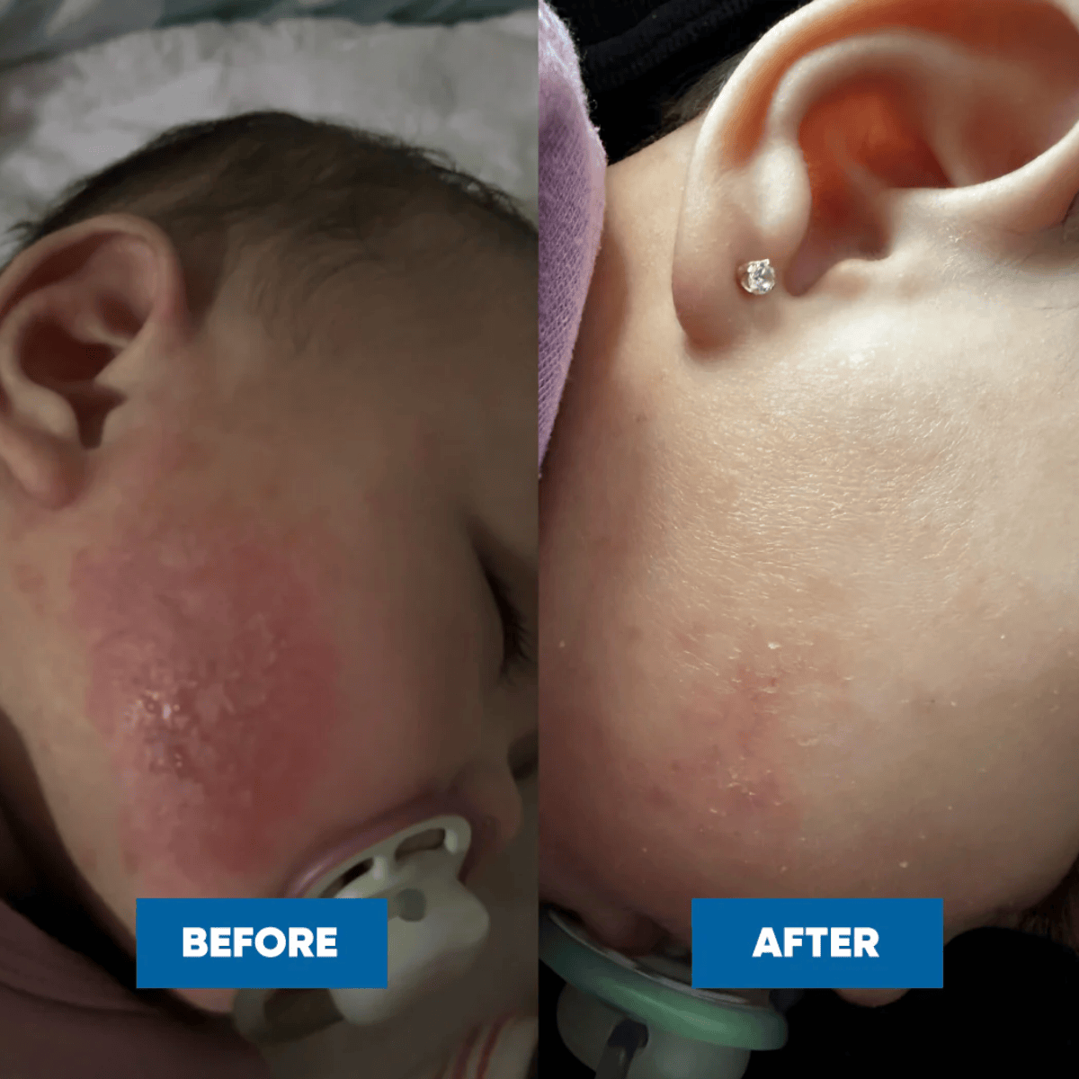 Before and after comparison of a child's ear with a visible earring.
